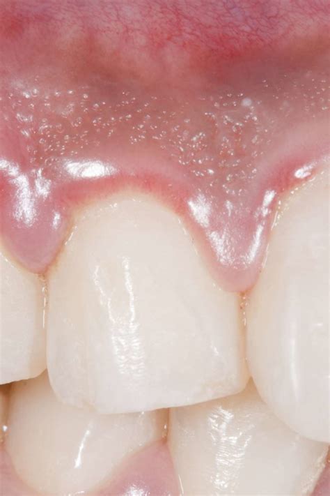 Swollen gums: Causes, treatments, and home remedies