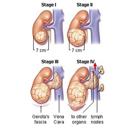 Wilm's Tumor - WAGR Syndrome