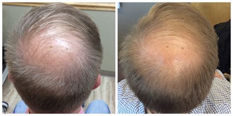 prp hair loss before and after - St Louis Lipo