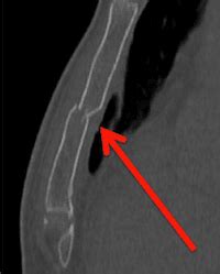 Should We Admit All Patients with Sternal Fractures?