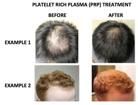 PLATELET RICH PLASMA (PRP) TREATMENTS — Donovan Hair Clinic