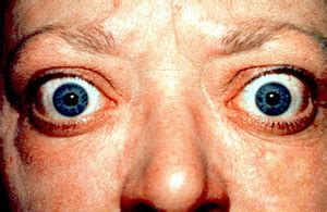 Exophthalmus – Wikipedia