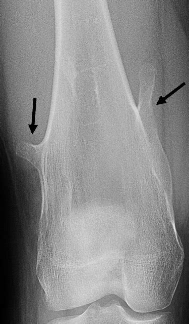 Osteochondroma