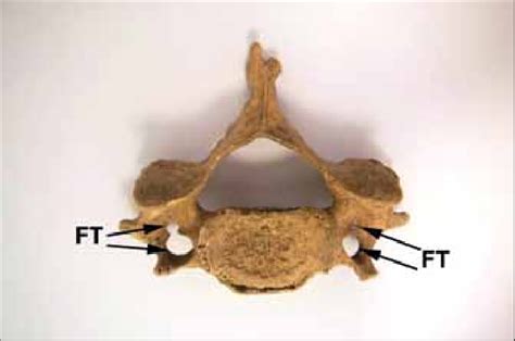 Bilateral duplication of foramen transversarium (FT). Figure 3 ...