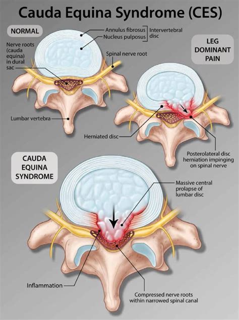 Cauda Equina Syndrome : Cause, Symptoms, Diagnosis, Treatment