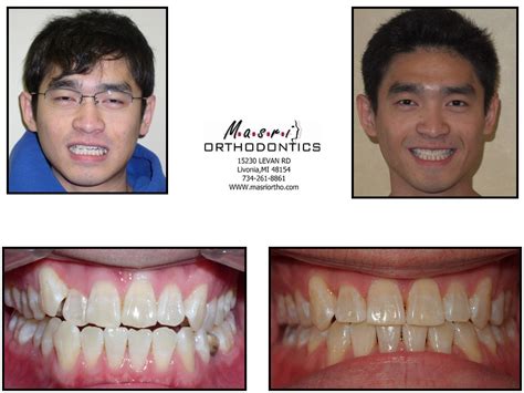 Open Bite Jaw Surgery & Braces Before and After Treatment