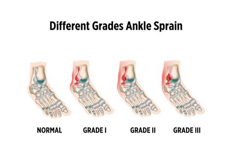 Ankle Sprains Different Types Grades | Hot Sex Picture