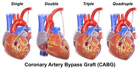 Coronary Artery Disease - CTVSA of Jacksonville, FL