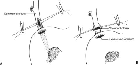 Choledochoenteric Anastomosis by Choledochoduodenostomy and Other ...