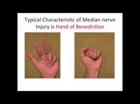 Image result for ape hand deformity | Median nerve, Nerve, Injury