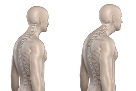 Thoracic Kyphosis Types, Causes, Symptoms, Treatment