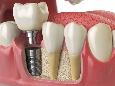 Dental Implants - Borough Dental Care Call Now on 0207 407 3883