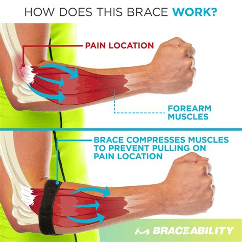 Epicondylitis Brace | Elbow Strap for Medial & Lateral Epicondyle Pain