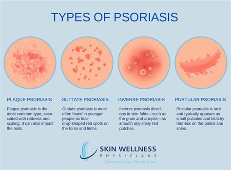 Guttate Psoriasis