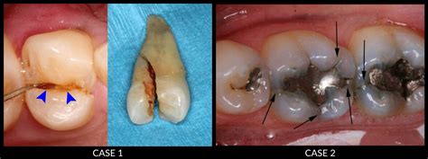 Broken Wisdom Tooth Extraction Cost