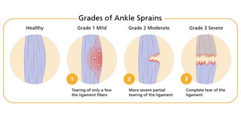 Ankle Sprain Grades 1