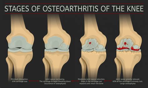 What Is Osteoarthritis Of The Knee Stages Symptoms Causes Diagnosis ...