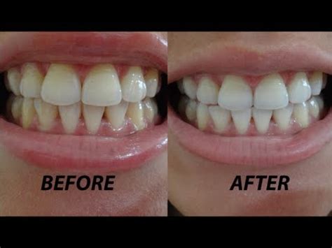 Crest 3D Whitestrips Vivid: Before & After, Demo + Review - YouTube