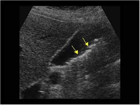 Abdomen and retroperitoneum | 1.2 Gallbladder and bile ducts : Case 1.2 ...