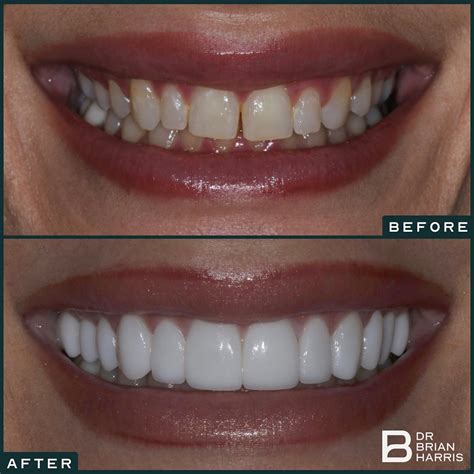 Smile Brighter Naturally: Teeth Whitening Insights