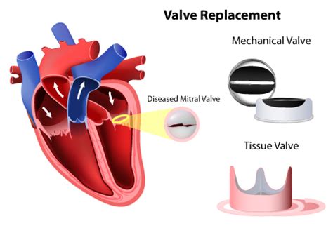 Beyond the Heartbeat: Mitral Valve Disease - Murmurs | NHCS