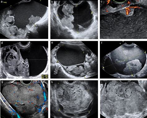 Ovarian Cancer Tumor Ultrasound