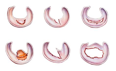 7 Types of Meniscus Tears and Treatments