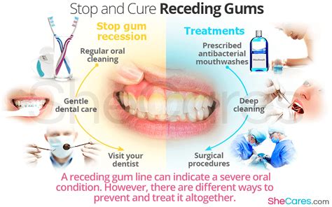 Stop and Cure Reciding Gums | Gum treatment, Receding gums, Gum ...