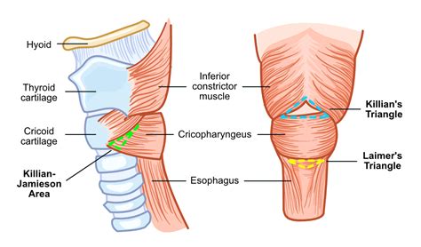 Zenker’s Diverticulum