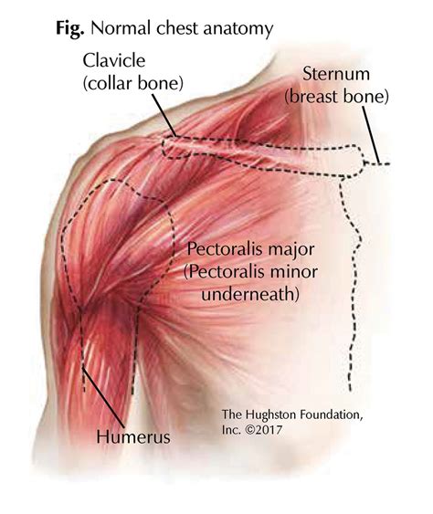 Chest Muscle Injuries: Strains and Tears of the Pectoralis Major ...