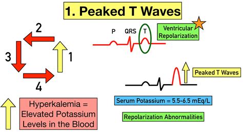 Hyperkalemia ECG Changes, Findings, and Progression of Effects on the ...