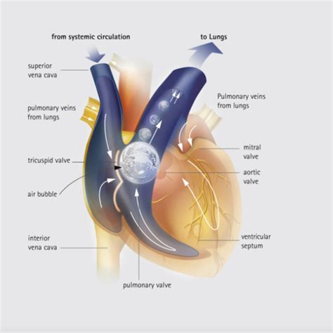 Air Embolism – Core EM