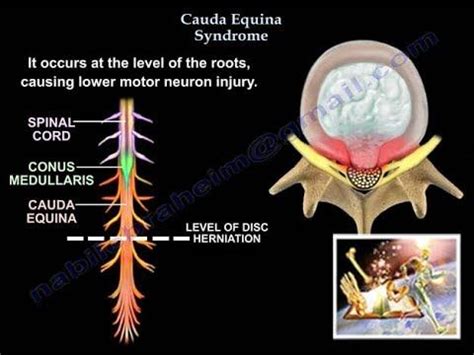 (454) Cauda Equina Syndrome - Everything You Need To Know - Dr. Nabil ...