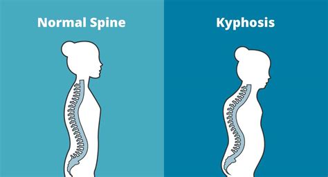 Kyphosis Causes, Symptoms & Treatments