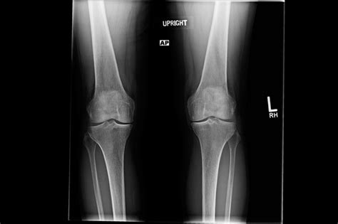 Ortho Dx: Bilateral Knee Pain Due to Osteoarthritis - Clinical Advisor