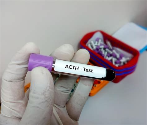 Premium Photo | Acth or adrenocorticotropic hormone blood test