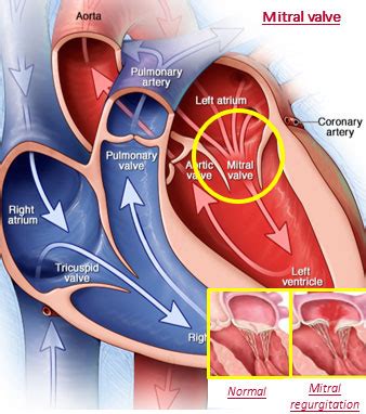 Mitral Valve Disease - HVR Cardio