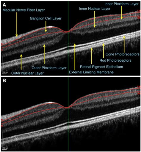 Layers Of Retina On Oct