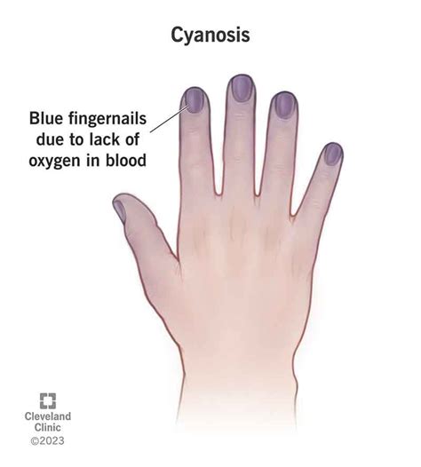 Cyanosis (Blue Hands & Feet): Causes, Treatment & Diagnosis