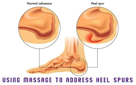 Using Massage to Address Heel Spurs | Massage Professionals Update