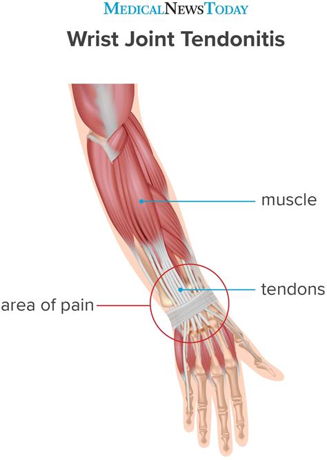 Wrist tendonitis: Treatment, symptoms, causes, and more