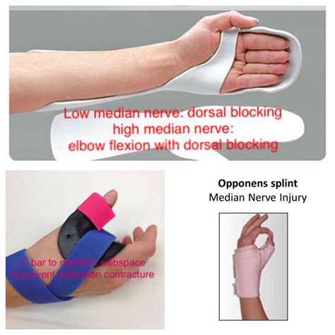 Median nerve injuries low: loss of thumb opposition and abduction with ...