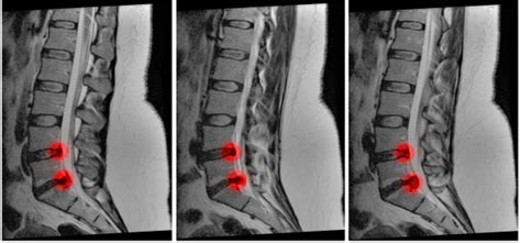 Learn to Spot and Treat Cauda Equina Syndrome - ACEP Now