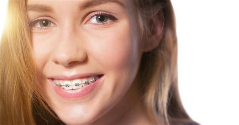 How Braces Help Get a Perfect Smile : Academy Dental: Cosmetic Dentists