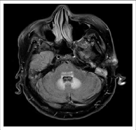 Hyperintense lesion of the dentate nucleus and middle cerebellar ...