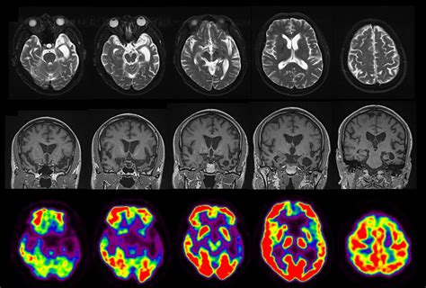 Severe left anterior temporal lobe atrophy is seen on T2-axial (A) and ...