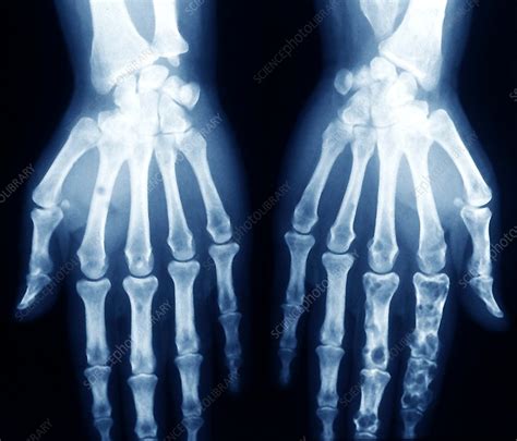 Hands in chondrodystrophy, X-ray - Stock Image - C029/9816 - Science ...