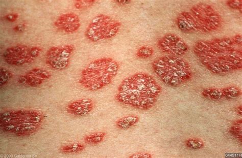 SKIN DISEASE TYPES: Guttate Psoriasis