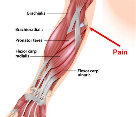 Golfer's Elbow - Symptoms, Causes, Treatment & Rehabilitation