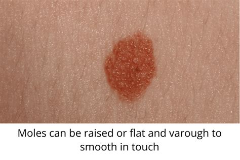 Skin Moles to Worry About – A Complete Guide With Skin Moles Pictures